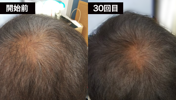 Oさん BeforeAfter