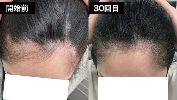 Oさん BeforeAfter